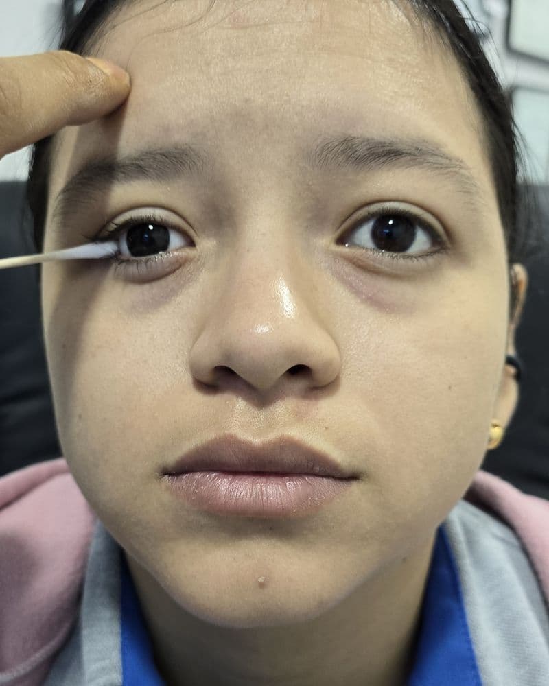 Ajuste de la prótesis ocular en consulta, con el paciente sentado