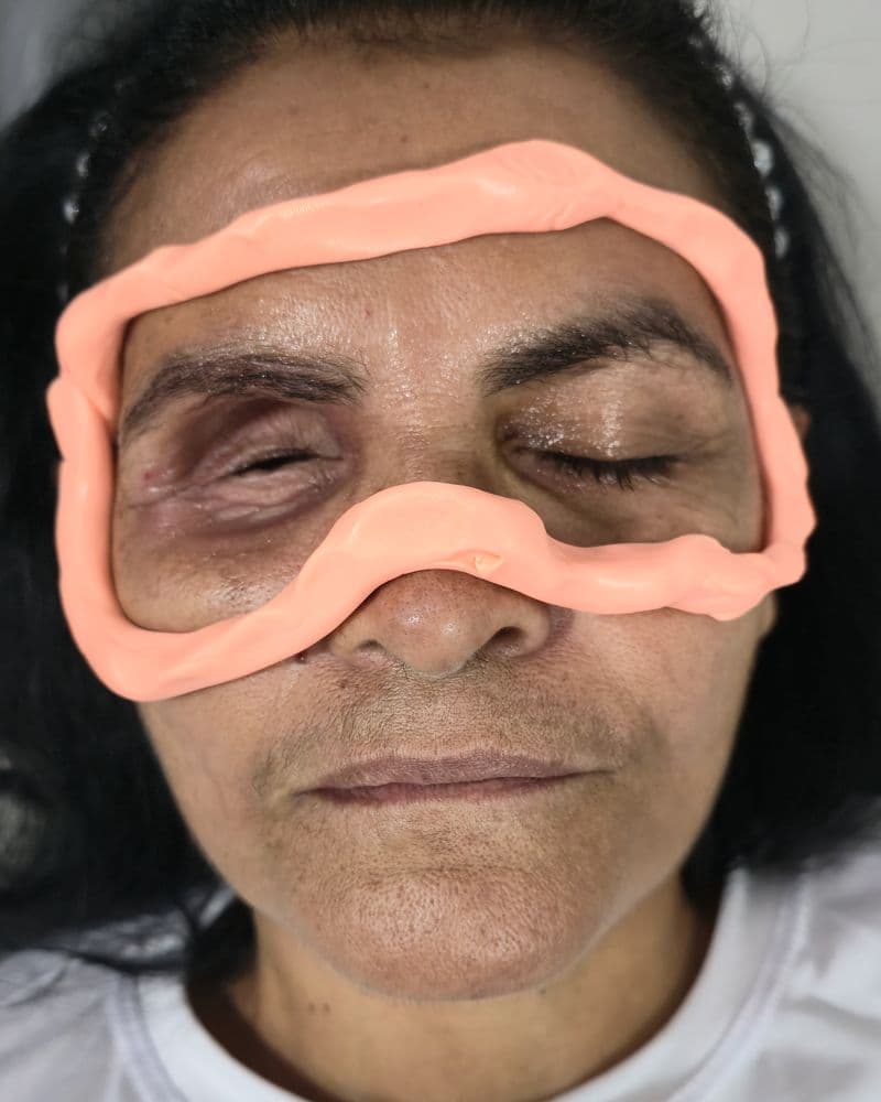 Paciente con el material de impresión facial aplicado sobre la órbita